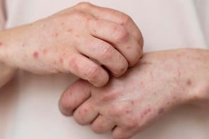El lupus es una de las enfermedades autoinmunes y como tal sus síntomas son variados.