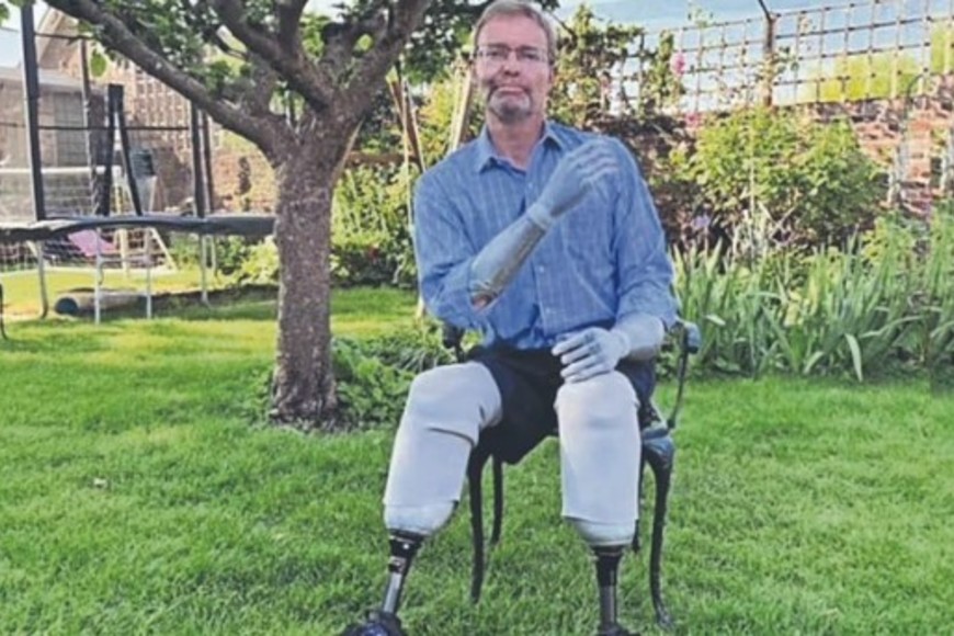 La sepsis es una afección poco común, pero grave, que se desarrolla cuando el sistema inmunológico del cuerpo reacciona exageradamente a una infección y comienza a atacar sus propios tejidos y órganos.