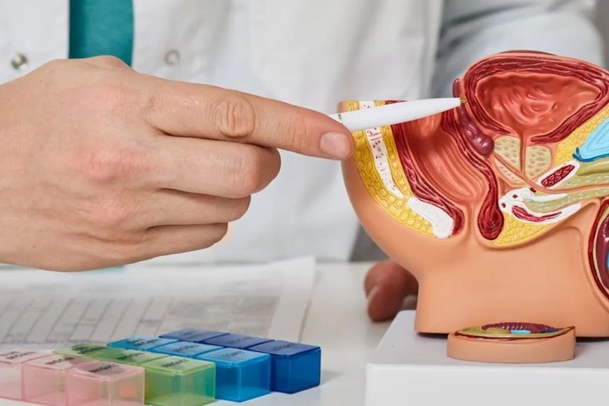 El cáncer de próstata es un tumor maligno que se origina en las células prostáticas