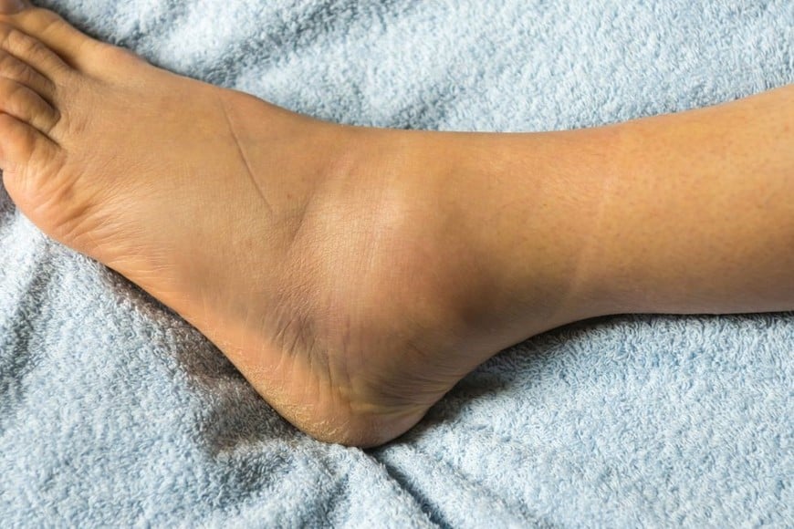 La hinchazón aparece rápidamente, acompañada a veces de hematomas