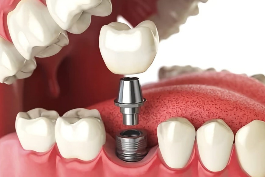 Los científicos esperan eliminar los implantes dentales.
