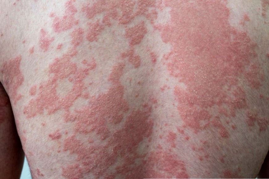 Impactan física y psicológicamente sobre la calidad de vida de quienes las padecen.