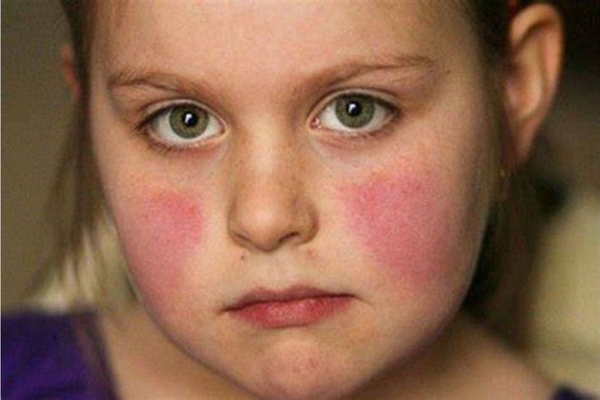 En los niños, suele manifestarse con un sarpullido eritematoso que comienza en las mejillas