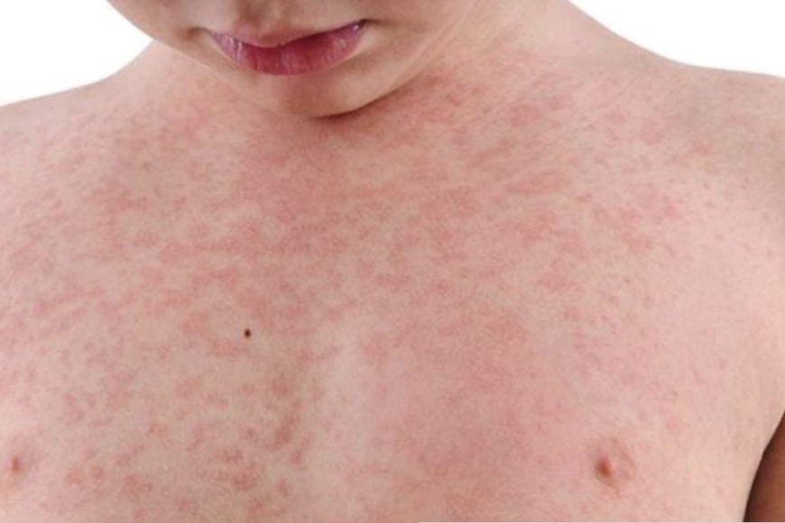 El periodo de incubación del parvovirus B19 varía entre 4 y 15 días