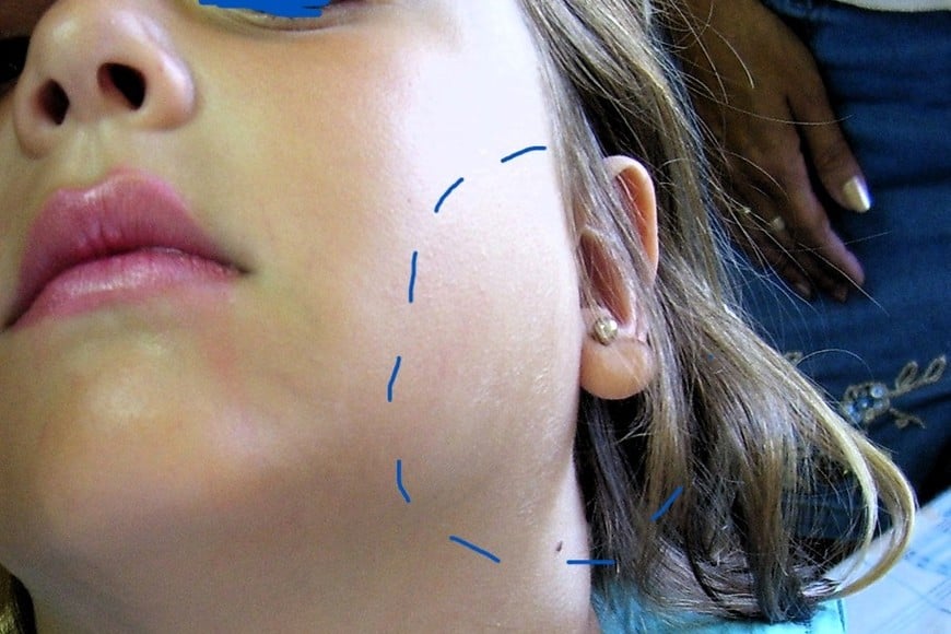 Niña afectada con papera, luego de inflar bombitas de agua.