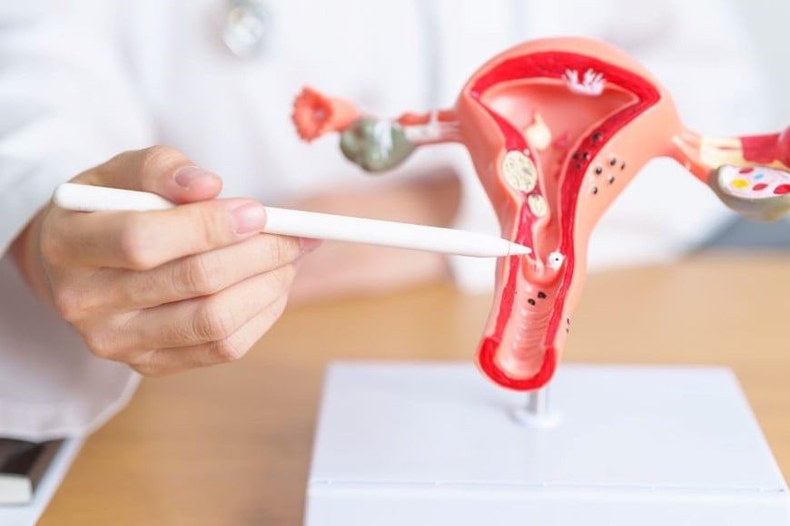 La endometriosis es una enfermedad que afecta al 10% de las mujeres en edad reproductiva