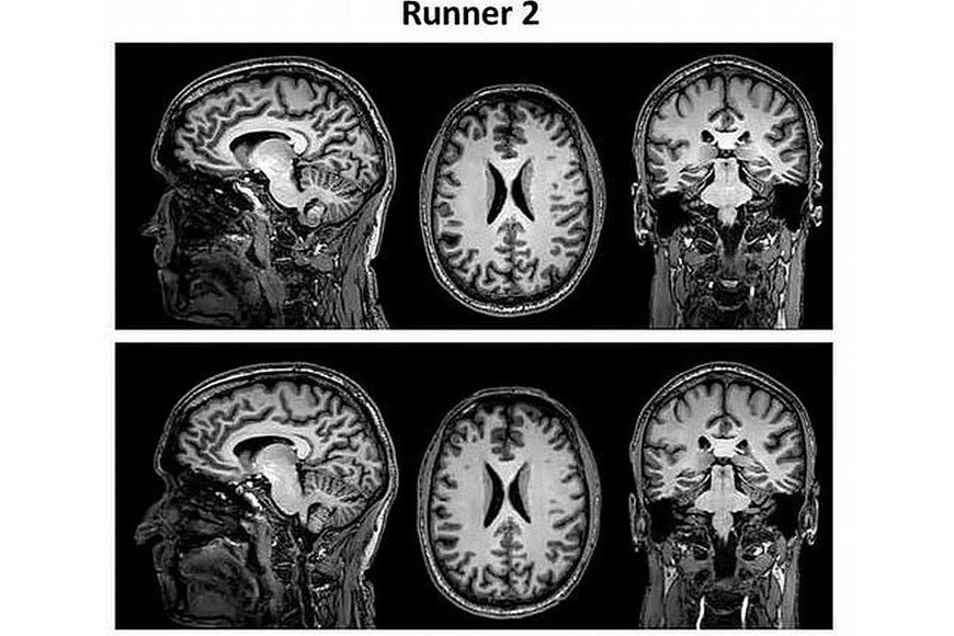 Resonancias magnéticas del corredor 1.