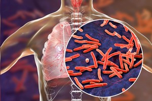 Los casos de tuberculosis aumentaron un 38% en lo que va del año. Gentileza