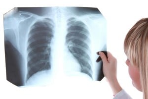 La tuberculosis puede estar alojada en cualquier órgano y presentar distinta sintomatología pero la búsqueda de quien transmite la enfermedad se hace sobre el paciente que tiene una localización pulmonar: persona mayor de 14 años que presenta tos y catarro por más de dos semanas.