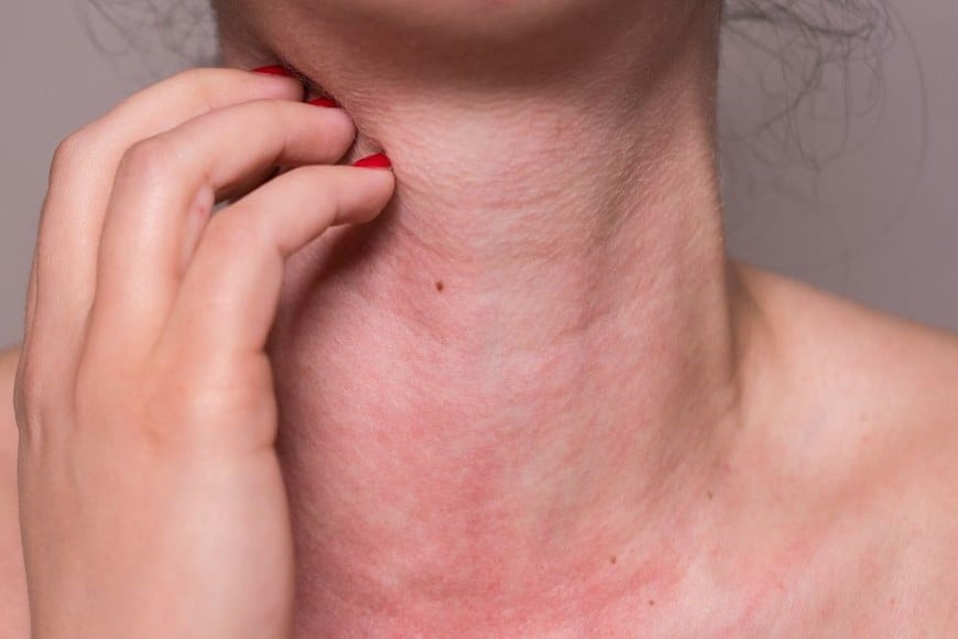 La tendencia a evitar productos que pueden causar alergias se intensificó en los últimos años