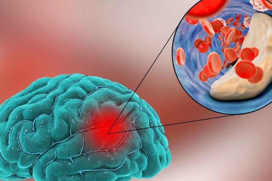 Dependiendo de su causa, puede ser isquémico (el más común) o hemorrágico, y también existe el “mini-ACV”