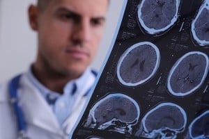 El ataque cerebrovascular (ACV), se define como un síndrome clínico de origen vascular,