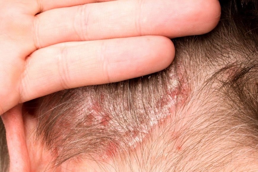 Alrededor del 1,5% de la población argentina vive con psoriasis