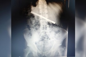 La impactante imagen de la placa radiográfica del interno de la cárcel.