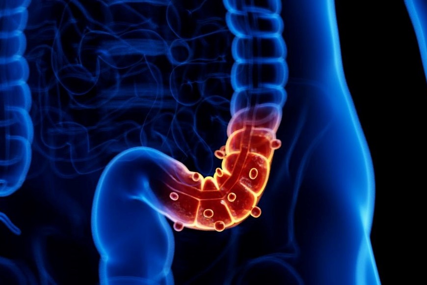 El tratamiento de la diverticulitis aguda varía según la gravedad.