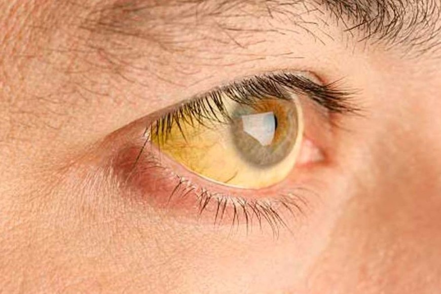 En los casos graves, “la piel y la esclerótica del ojo se tiñen de un tono amarillento por el daño hepático”.