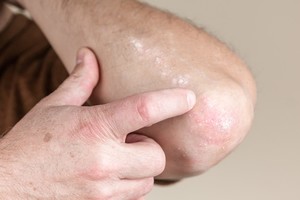 Nueva campaña en Santa Fe para concientizar sobre la enfermedad psoriásica.