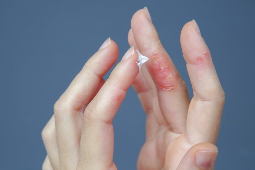 Diferentes formas clínicas de presentación de la afección.