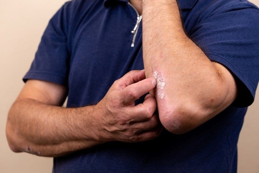 Placas cutáneas típicas de la psoriasis en la piel.