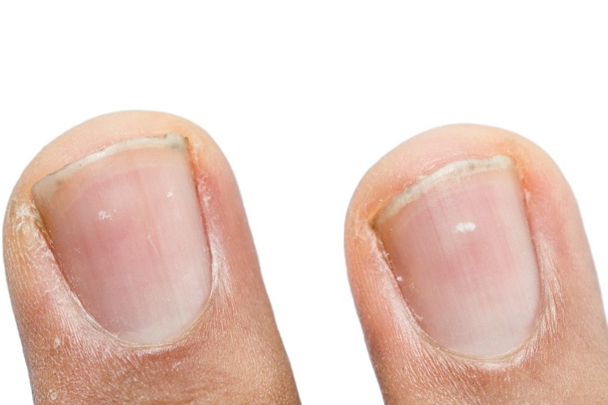 Manchas blancas en las uñas