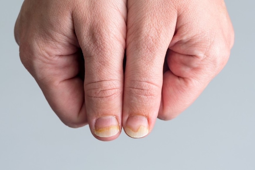 Estrías en las uñas