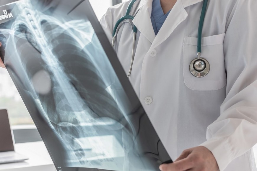 El cáncer de pulmón es la primera causa de muerte por cáncer en Argentina