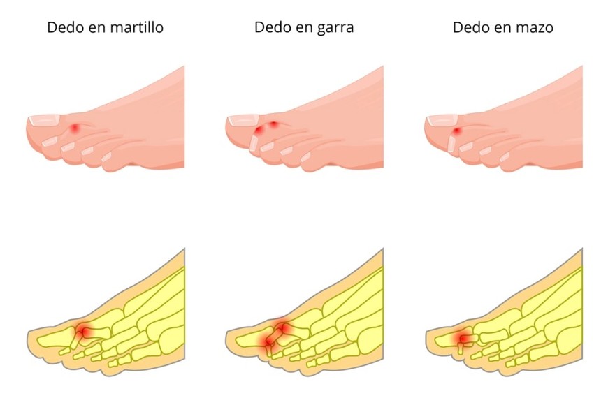 Tipo de malformaciones más comunes
