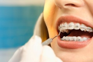 La comercialización y la distribución de una partida de brackets para ortodoncia falsificados