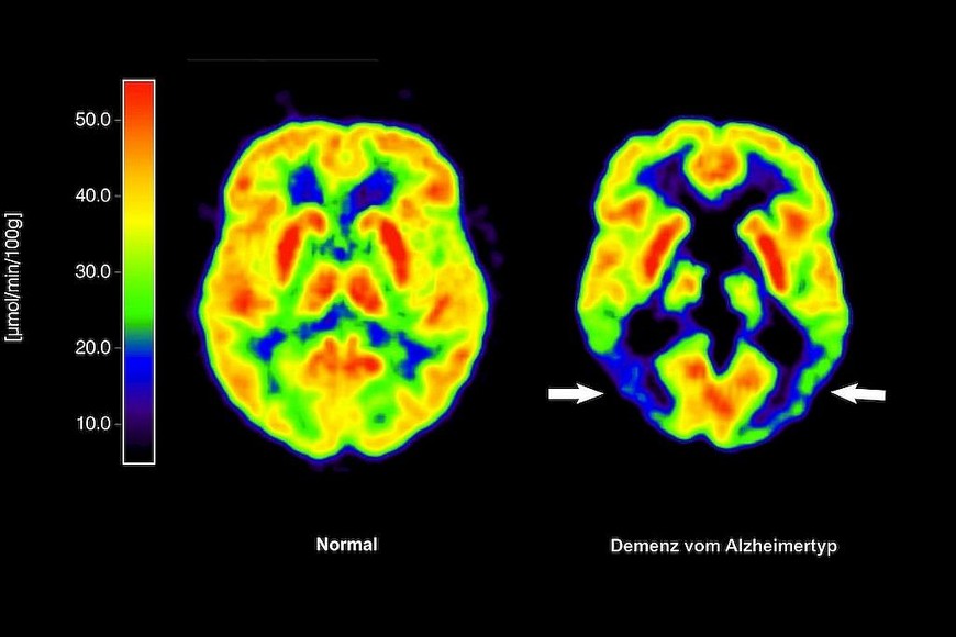 Una dieta alta en grasas reconfigura el hipocampo en solo cuatro días, afectando la memoria.