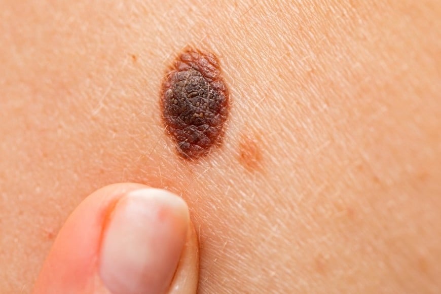 En EE.UU. se diagnostican más de cinco millones de casos de cáncer de piel al año