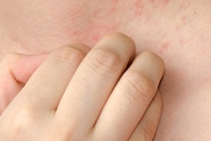 La fecha se celebra para combatir la estigmatización de quienes viven con esta condición.