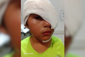 Santa Fe: una nena de 8 años fue atacada por un pitbull en el rostro en barrio Los Hornos - Image 1