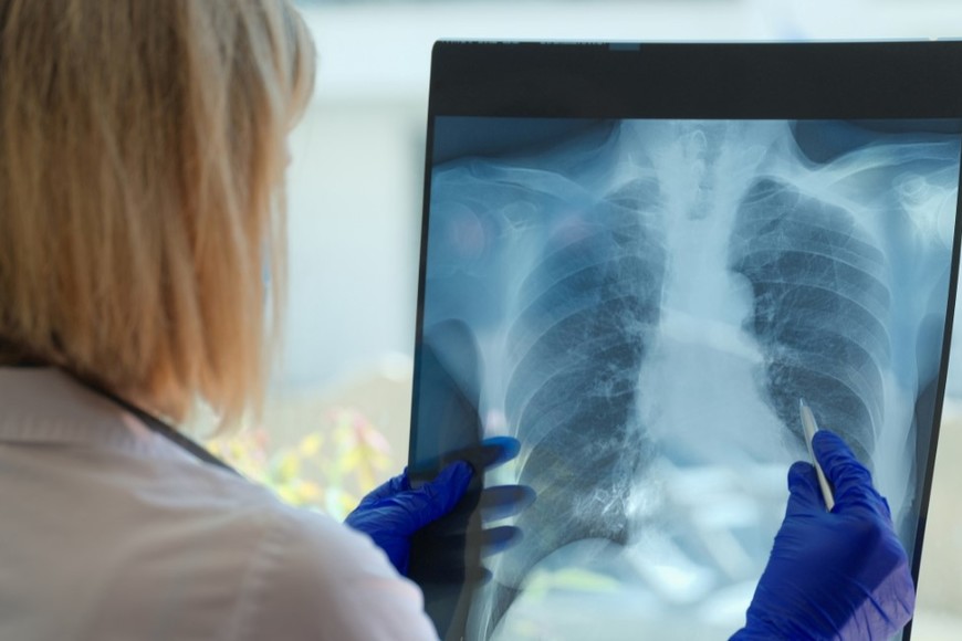 El 85% de los pacientes tiene antecedentes de tabaquismo, activo o pasado.