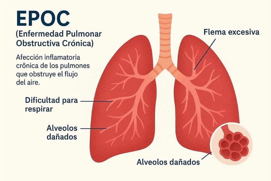 El EPOC es una enfermedad crónica caracterizada por inflamación en las vías respiratorias