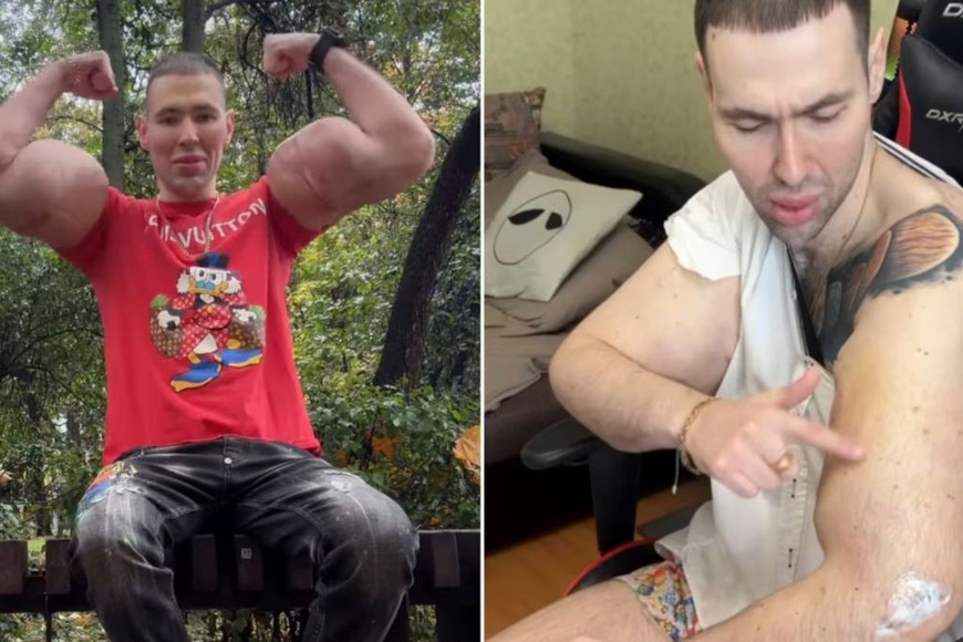 Kirill Tereshin, el influencer ruso que se quiso parecer a Popeye y ahora podría perder los brazos.