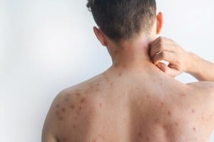 El brote detectado con estos viajeros se suma a una serie de casos confirmados