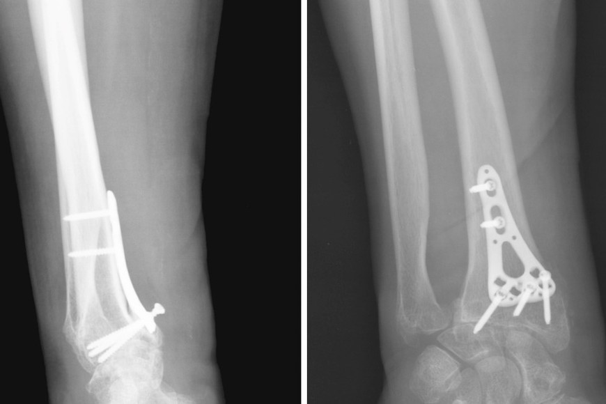 Pplacas, tornillos y otros insumos de osteosíntesis sin el registro correspondiente.
