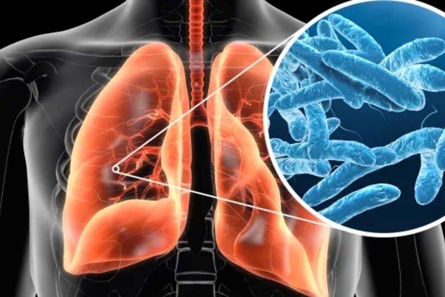 La legionelosis es una enfermedad pulmonar grave causada por la bacteria Legionella