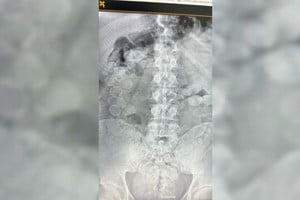 Impactante imagen de rayos X donde se observan las cápsulas con cocaína.  Foto: Gentileza