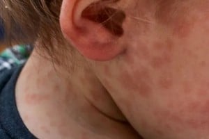 Se confirmó con laboratorio positivo el caso de sarampión en un niño de dos años, de Santa Elena.