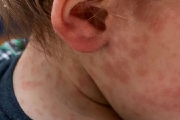 Se confirmó con laboratorio positivo el caso de sarampión en un niño de dos años, de Santa Elena.