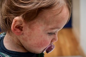 Autoridades insisten en acudir de inmediato ante síntomas como fiebre y manchas en la piel.