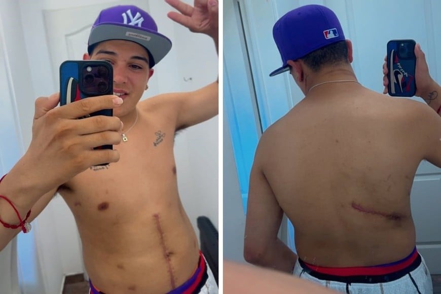 Thiago Medina mostró en sus redes fotos de las heridas que casi le costaron la vida.