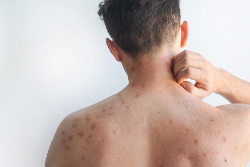 El brote se da en medio de bajos índices de inmunización