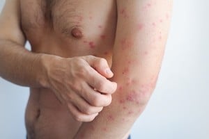 Las autoridades sanitarias de Carolina del Sur confirmaron un aumento acelerado de casos de sarampión