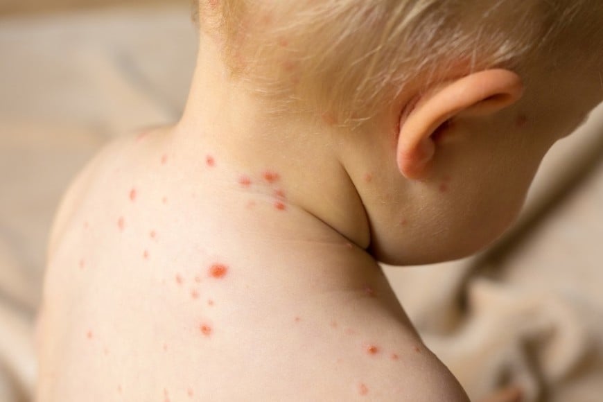 El período de cuarentena se extiende hasta 21 días después de la última exposición