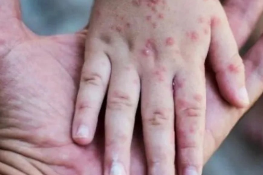 Las autoridades sanitarias activaron el protocolo correspondiente