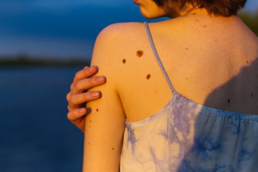 La radiación ultravioleta es un carcinógeno conocido.