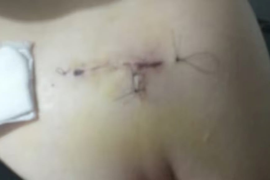 La gravedad de la herida.