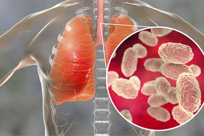 El informe detalla que la coqueluche afectó a personas de todas las edades